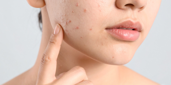 Comment prendre soin d’une peau à imperfections ?